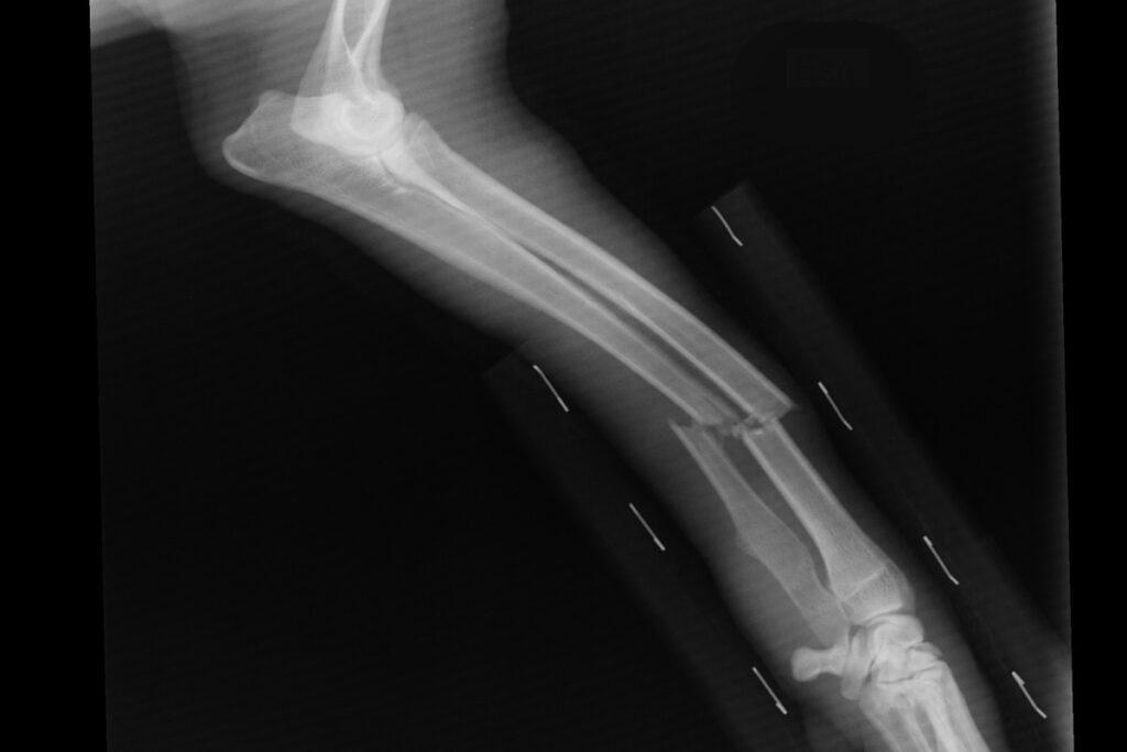 Nursing Home Errors: When Mistakes Become Broken Bones